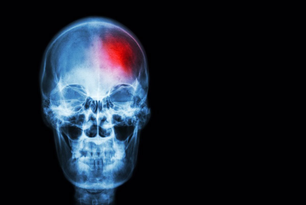 Los factores de riesgo ambientales y metabólicos incrementan la incidencia de accidentes cerebrovasculares.