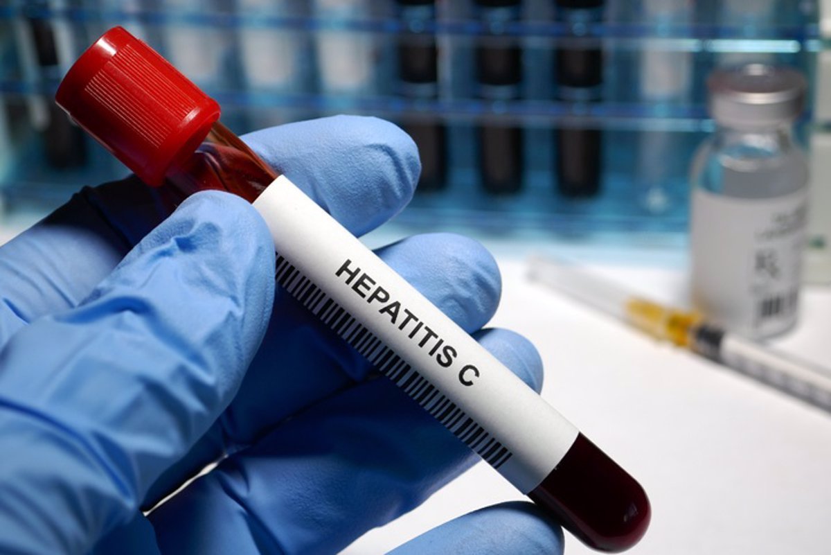 Infradiagnóstico de la hepatitis C persiste en España, según expertos