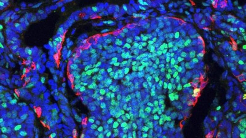 Las células cancerosas compiten en desarrollo de tumores.